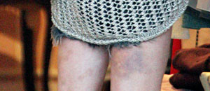 Lindsay Lohan tiene moretones en sus piernas (Fotos)