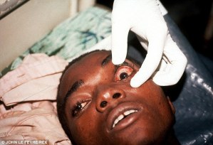 Los síntomas del ébola incluyen sangrando de las mucosas: Impactante FOTO
