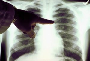 El cáncer de pulmón puede estar inactivo durante 20 años