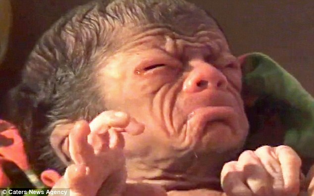 Un bebé nace con la enfermedad de “Benjamin Button” (Video)