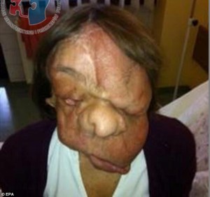 ¡OMG! Así luce una mujer a tres años de haberse trasplantado la cara (Fotos)