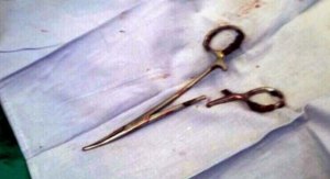 Retiran unas tijeras que llevaban 18 años en el estómago de un vietnamita