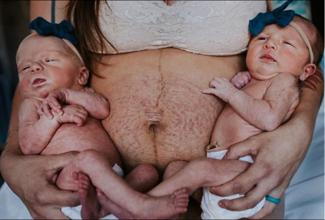 Madre orgullosa muestra sus estrías después del parto - Foto: @th3littlestavenger