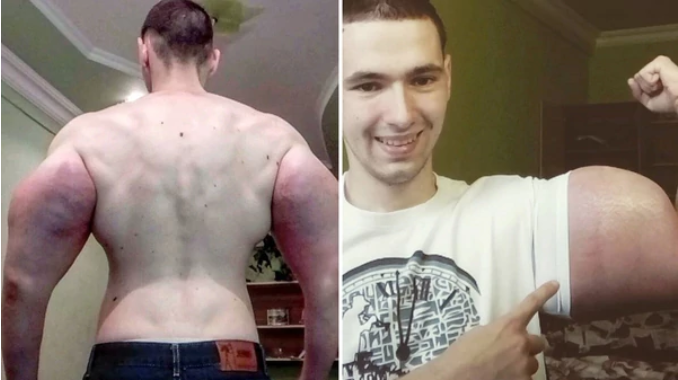 Conoce al Popeye ruso, un joven que se inyecta aceite en los brazos (fotos)