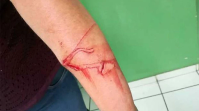 Así quedó el brazo de la maestra luego de la agresión de su alumno. Foto Infobae