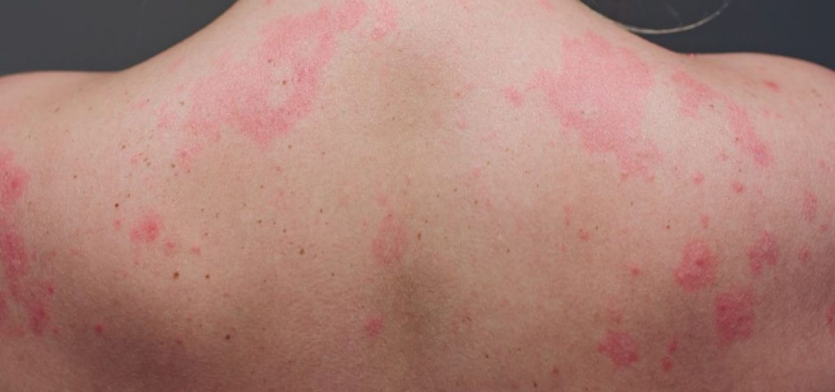 Manchas en la piel delataría presencia de coronavirus en pacientes asintomáticos