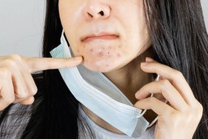 ¡No pierdas tu belleza! 5 consejos para evitar el acné causado por las mascarillas