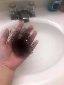 Sobrevivientes del Covid-19 en EEUU experimentan una pérdida de cabello “desgarradora”