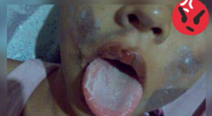 ¡Horror en Valles del Tuy! Le quemó la cara a su hija de siete años porque se comió un arroz a escondidas