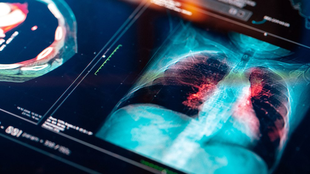 Cómo el Covid-19 puede desencadenar niveles críticos de inflamación pulmonar