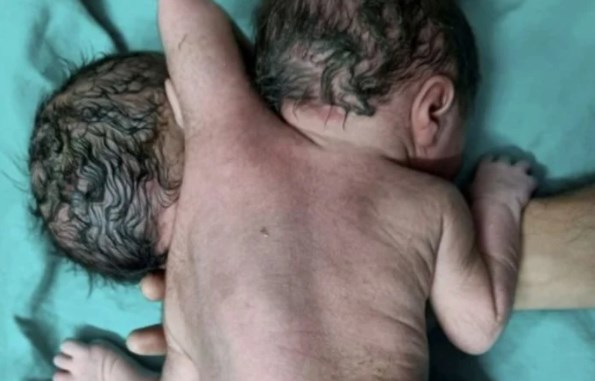 El bebé que espera el milagro: nació con dos cabezas, tres manos y dos corazones