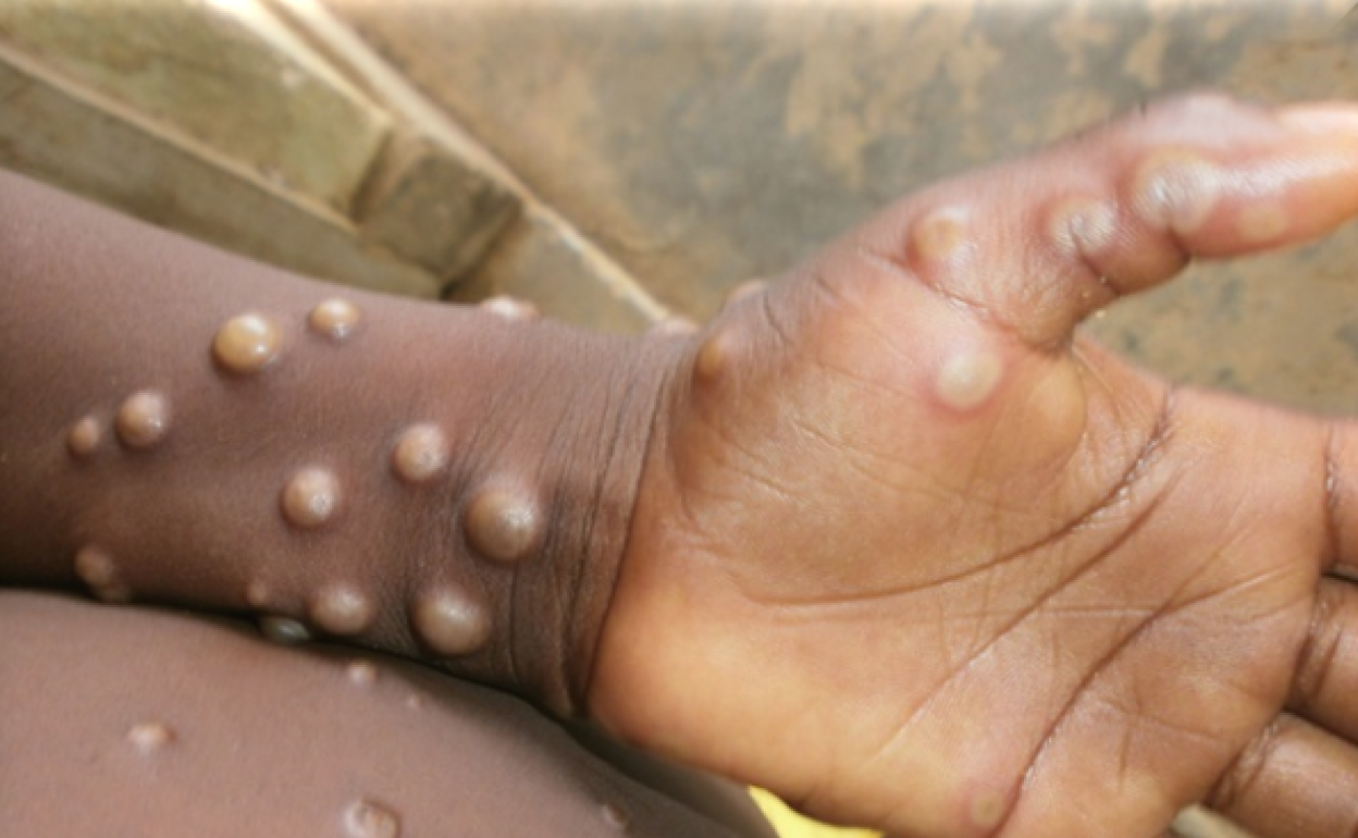La EMA aprueba “Imvanex” como vacuna contra la viruela del mono