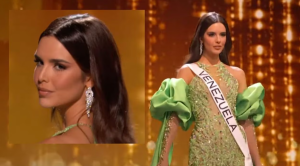 Amanda Dudamel, Miss Venezuela, mostró cómo lucía antes de someterse a un procedimiento en su rostro