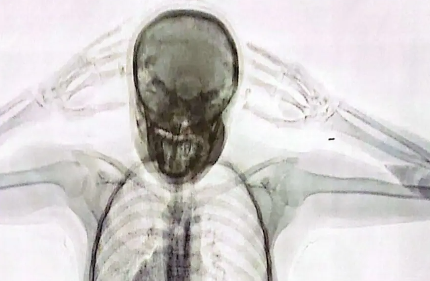 FOTO de rayos X: así se ve en un escáner el cuerpo de una “mula” repleto de cápsulas de cocaína